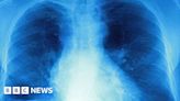 Access to cystic fibrosis drugs approved in England