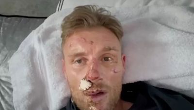 Freddie Flintoff reveals full extent of facial injuries as viewers all say same thing