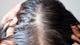 It's not just brain fog: Vertigo, hair loss, and lagging sex drive are also long COVID symptoms