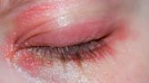 What Is Eyelid Dermatitis - A Condition That Aggravates In Monsoon; Know Ways To Prevent It