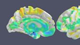 Scientists Name New Type of Memory Loss Often Mistaken For Alzheimer's