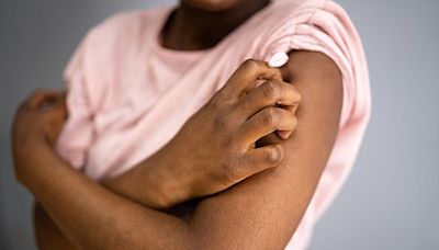 Racial differences identified in frequency of biopsy for psoriasis