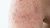 Qué es la dermatitis atópica y por qué el diagnóstico temprano mejora la calidad de vida