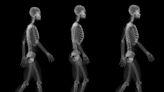 Ostéoporose : découverte dans le cerveau d'une hormone capable de solidifier les os
