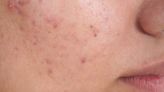 Acne scarring: Symptoms, Treatments, Causes, Tests & Preventions