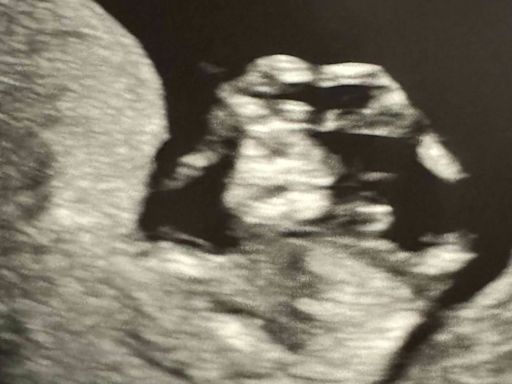 Pregnant Swiftie shares sonogram of her unborn baby imitating Taylor Swift