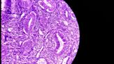 Failing to remove abnormal cells increases risk of cervical cancer, BMJ study suggests