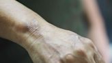 Signs and Symptoms of Leprosy