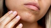 How To Get Rid Of (And Prevent) Chin Acne