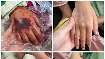 8歲女童感冒迅速惡化 進加護插管、洗腎！一查竟染罕見「食人菌」