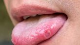 Tongue symptom could be red flag for Covid as new variant causes concern