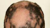 Hair Loss (Alopecia)