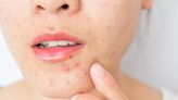 What Is Perioral Dermatitis? 2 Dermatologists Explain the Skin Condition