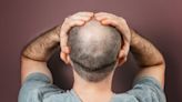 Hammerling-Hodgers: Losing your hair? Here are some reasons why and what you can do