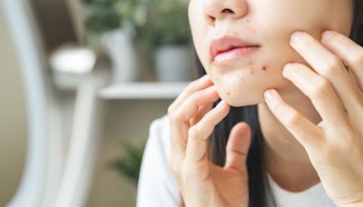 Une étude nous dit quoi manger contre l'acné (voici la liste des aliments à privilégier !)