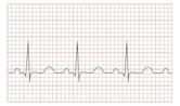 Tachycardia