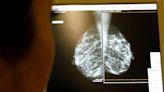 Breast cancer screening should begin at age 40, U.S. panel says