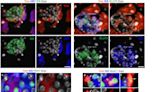 Repurposed cancer drug could treat diabetes by nudging pancreatic acinar cells to produce insulin