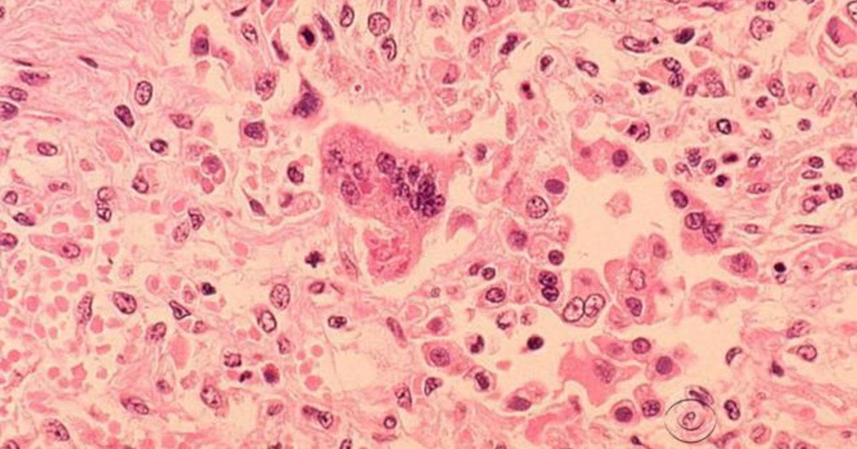 Siblings with measles could have exposed others at HCMC, state health department says