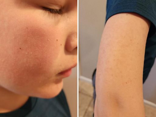 'Slapped cheek disease' is raging through NJ schools right now