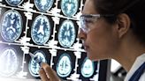 Donanemab, el nuevo medicamento que supone un "punto de inflexión" en el tratamiento del alzhéimer