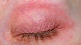 What Can Cause a Rash Around the Eyes?