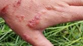 Giant Hogweed Burns: How to Avoid the Plant and Treat the Reaction