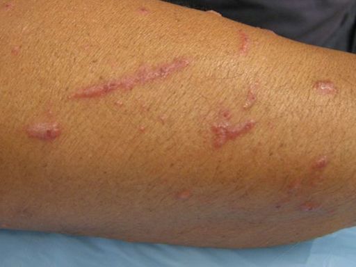 What a Grass Rash Looks Like and How to Find Relief