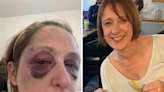 Gran battered black & blue by feral gang who stamped on her head at beauty spot