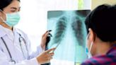 Parasitic worm infection in TB patients makes lung disease more severe, finds study - ET HealthWorld