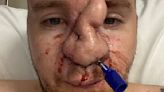 Epilepsy sufferer 'heartbroken' after nose ripped off by pet dog