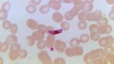 Monoclonal antibody offers strong malaria protection in children
