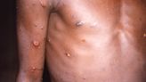 Mpox spreads to another DR Congo province