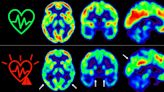 Empezar cuanto antes a cuidar la salud cardiovascular es bueno también para el cerebro