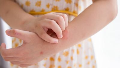 The 12 steps to ease your child's agonising eczema from cold rooms to bath toys