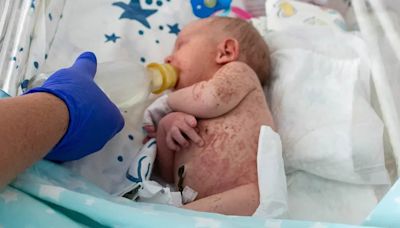 Newborn covered in bites and sunburn after being left on ant hill