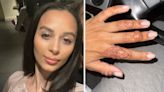 Henna tattoo left woman's hand scarred for 2 years after an allergic reaction