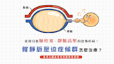 【李紹榕醫師】重則引發肺栓塞、靜脈高壓的恐怖疾病！髂靜脈壓迫症候群怎麼治療？