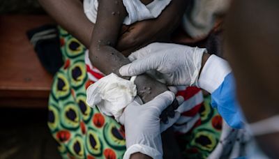 Fast-Spreading Mpox Variant Detected in Congo City of 17 Million