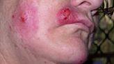 Staph Infection Stages and Pictures