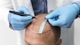 Alopecia masculina: ¿A qué edad es mejor hacerse un trasplante de pelo?
