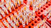 Combining blood test with AI may mean more accurate sepsis diagnosis