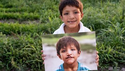 Samir, el chico tucumano con fisura labio palatina al que dos cirugías le devolvieron la sonrisa y el futuro