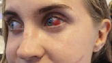 Uñas postizas de rival causan una horrible lesión en el ojo de futbolista