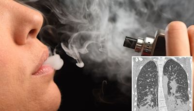 Woman fighting for life after vaping leaves lungs looking like 'shattered glass'