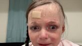 TikToker, 16, with Agonizing Skin Disorder That Causes Blisters and Tearing Shares 'Get Ready With Me' Videos (Exclusive)