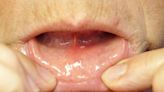 Mouth Ulcer (Canker Sore): Everything You Need to Know