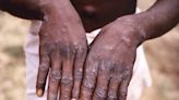 What to know about monkeypox symptoms as the virus spreads in an unusual way across the US and Europe