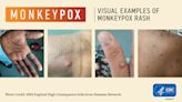 Monkeypox case reported in St. Clair County, according to state
