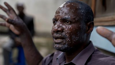 WHO chief poised to declare international health emergency as mpox spreads in Africa